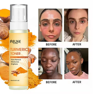 AILKE Organic Turmeric Vitamin C Facial Essence Toner – Anti-Acne, Brightening & Hydrating (100ml) wellvy wellness store