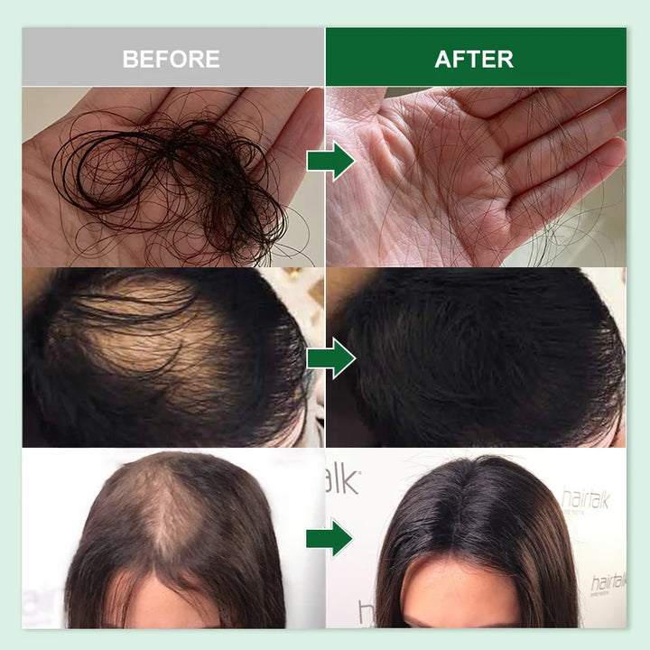 Revitalize with PURC Rosemary Hair Growth: Men & Women's Anti Hair Loss Solution